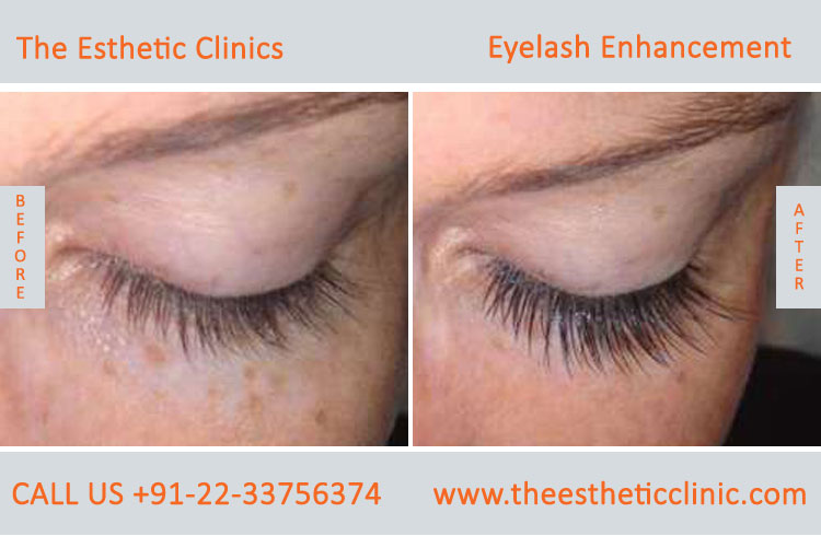 Eyelash Enhancement Surgery, Latisse Eyelash Treatment before after photos in mumbai india (5)